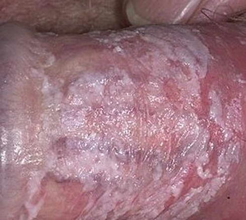 écoulement caillé lorsqu'il est excité