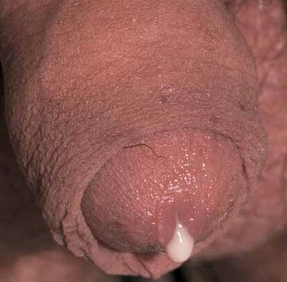 écoulement pathologique lorsqu'il est excité